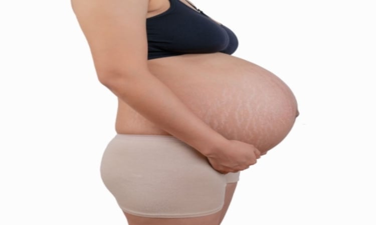 Stretch marks during pregnancy