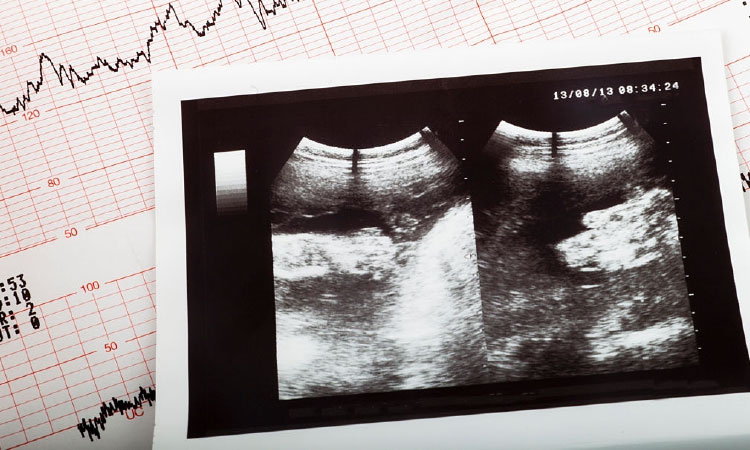 What Can Be Done When Fetal Heartbeat Stops Suddenly