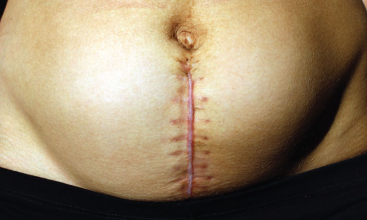 C-Section Scar Itching – Is This Normal