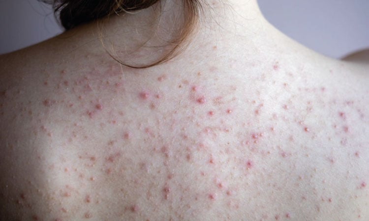 Signs Of Back Acne During Pregnancy