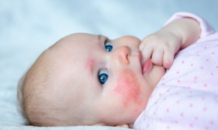 Infantile acne skin problem in babies