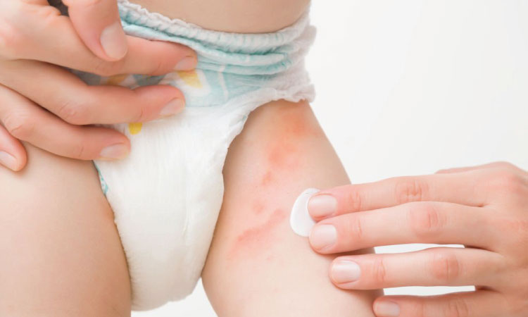 5 Simple Remedies For Diaper Rashes